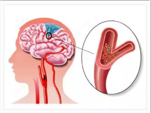 天津博粹中医医院：中风的预警信号，不看一定后悔！