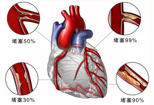 乌兰察布蒙中康复医院：（医案）三氧大自血疗法治疗“高血脂”