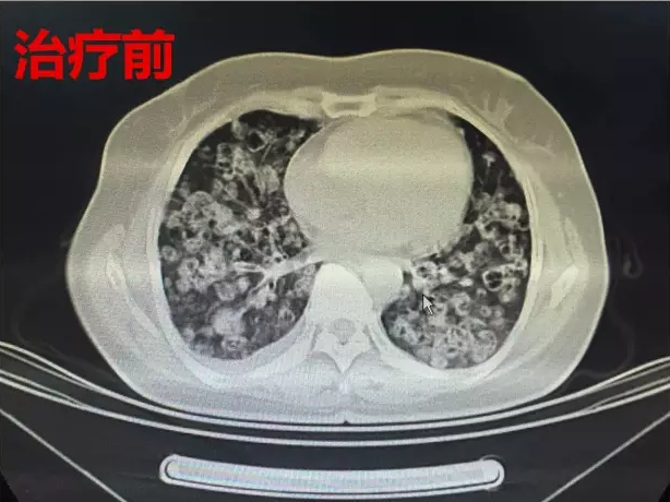 天津市武清区中医医院：（医案）个体化治疗胸外科腺癌