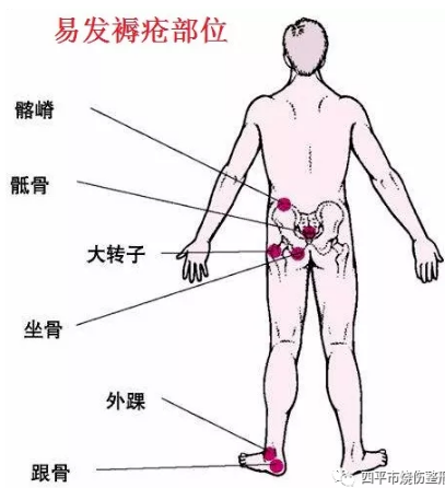 四平市烧伤整形医院：有褥疮不用慌，烧伤医院把您帮