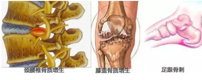 长春市馨康中医院：骨质增生疾病的明显症状！