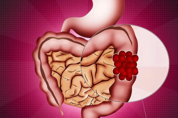 北京三溪堂：什么样的肠息肉更容易癌变？