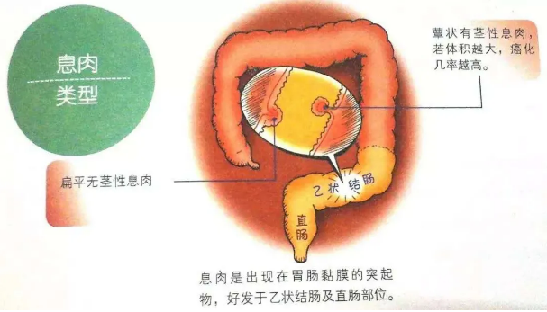 鞍山益仁康肛肠医院：警惕！这四大常见原因导致肠息肉……