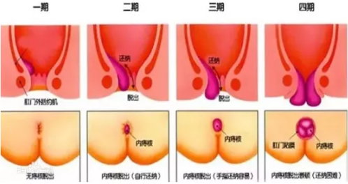 鞍山益仁康肛肠医院：痔疮到什么程度需要做手术？