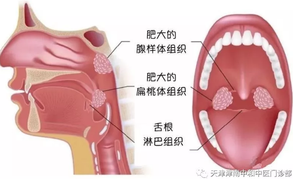 津南中和中医门诊部：如何应对小儿腺样体肥大