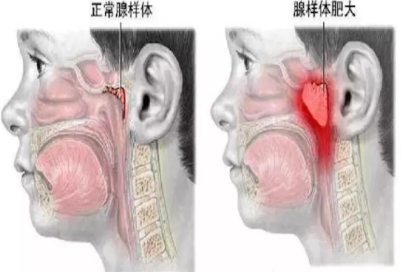 津南中和中医门诊部：如何应对小儿腺样体肥大