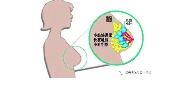 丽水缙云县杭生堂中医馆：柴胡疏肝散治疗乳腺增生医案