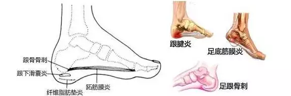 惠州葛洪国医馆：走路久足跟部反复疼痛？——陈志杰医生病例介绍