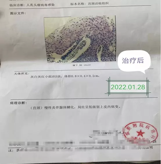 淄博赵树堂中医馆：特聘济南专家王群大夫经方合用治愈HPV感染导致宫颈癌前病变1例