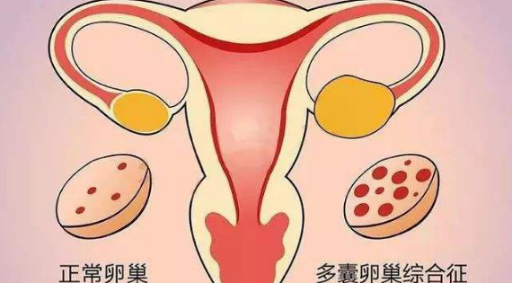 郴州正心中医馆：刘佐龙治疗多囊卵巢