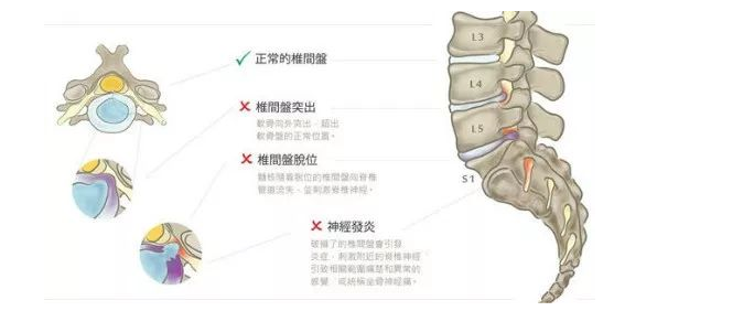 湘潭执一堂中医医院：朱水生治疗腰椎间盘突出症