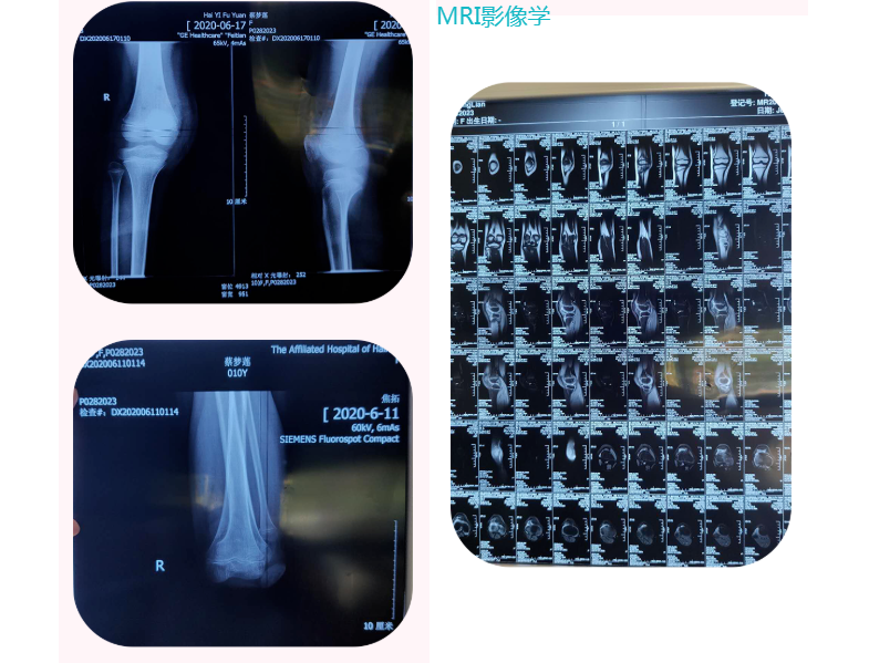 海口寻道中医馆：右腿髌骨脱位术后康复治疗案例