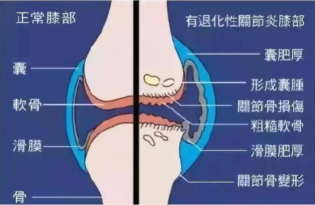 永州恒康中医医院：温针灸治疗左膝疼痛乏力