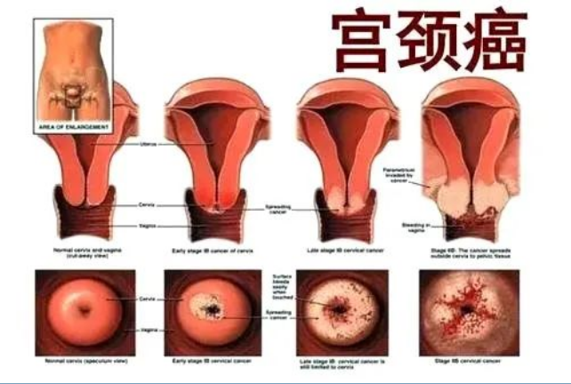 昆明岐轩中医馆：薛源清调理宫颈癌术后恢复