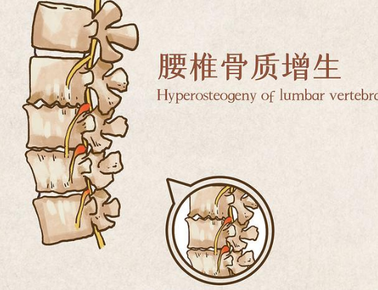 普洱淞茂中医馆:张加云治疗腰椎骨质增生