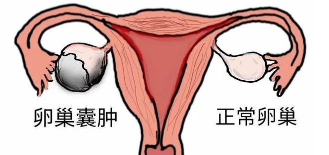 普洱淞茂中医馆：许健康治疗卵巢囊肿