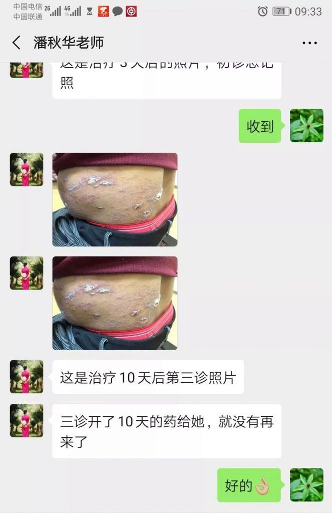 普洱淞茂中医馆：潘秋华治疗带状疱疹