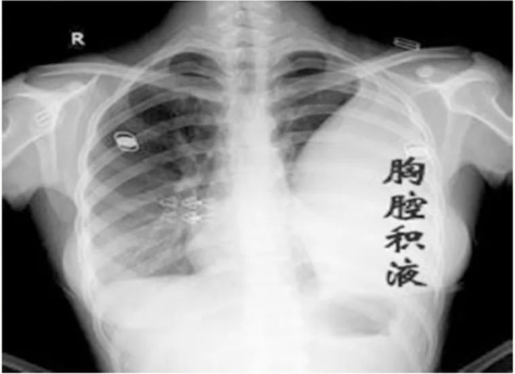 深圳维明生中医馆：右肺腺癌患者，抽水引流效果不佳，转而寻求中医药治疗