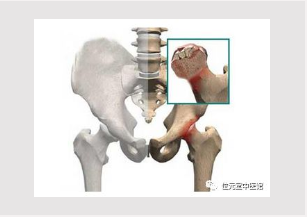 深圳位元堂中医馆：股骨头坏死，幸得遇见你