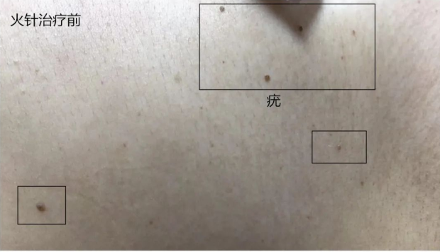 广州紫和堂国医堂：翟颖珏医师火针祛扁平疣、丝状疣