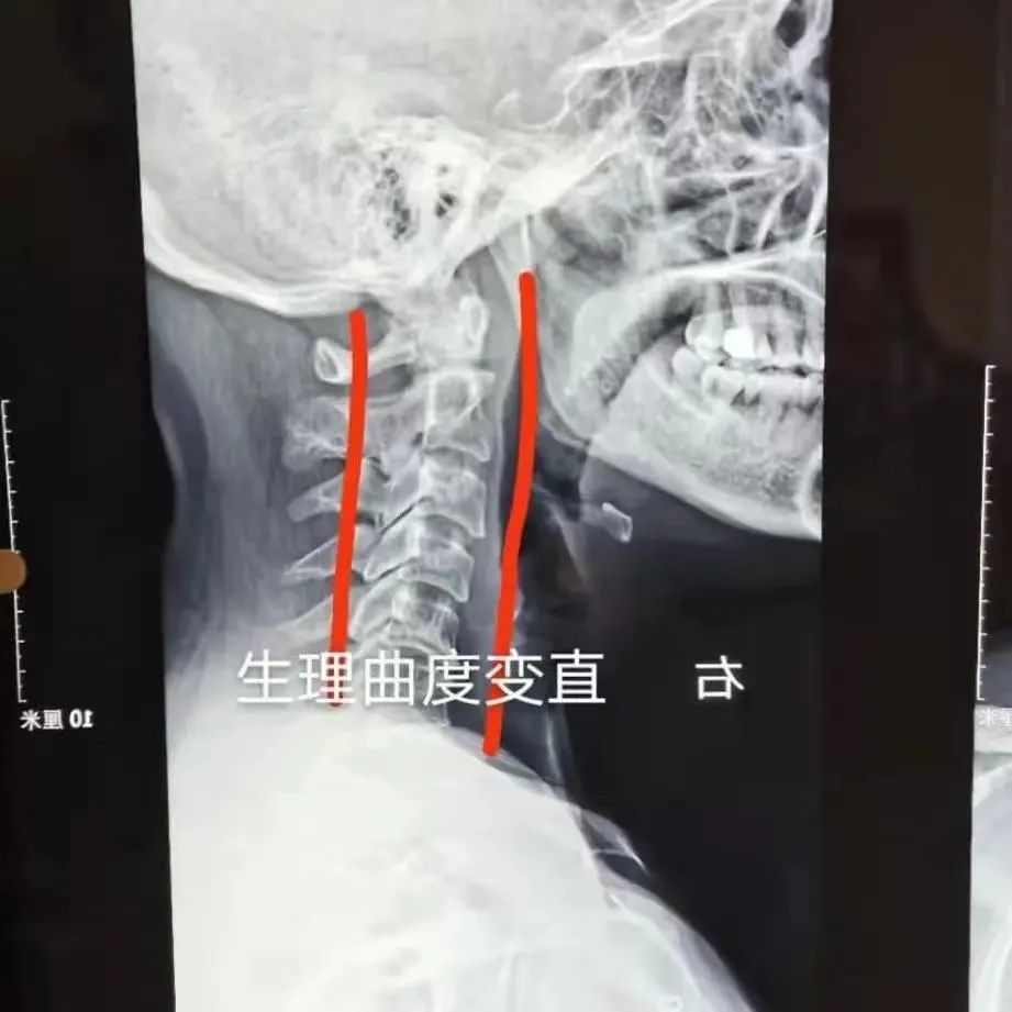 广州紫和堂国医馆：梁德明医师治疗重症肩周炎治案一则