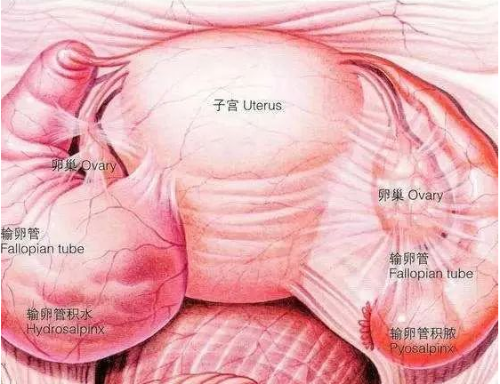 郑州管城康氏中医馆：输卵管积水引起腹痛