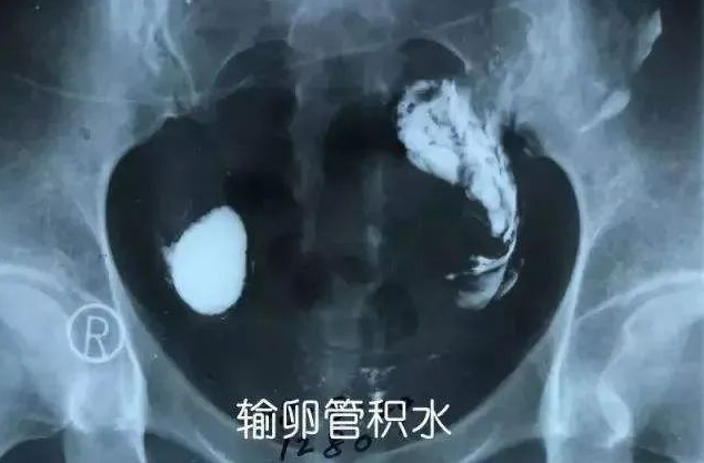 郑州管城康氏中医馆：输卵管积水引起腹痛