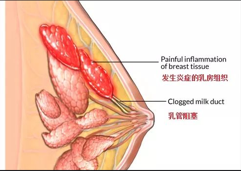 邢台赵云涛中医工作室：运用纯中药治疗急性乳腺炎高热不退案例分享