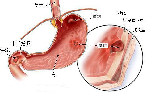 武汉诚顺和中医门诊部：张压西教授治疗慢性萎缩性胃炎3年，上腹隐痛胀满伴嗳气泛酸反复发作