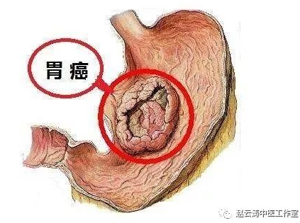 邢台赵云涛中医工作室:胃癌术后案例分享（1）