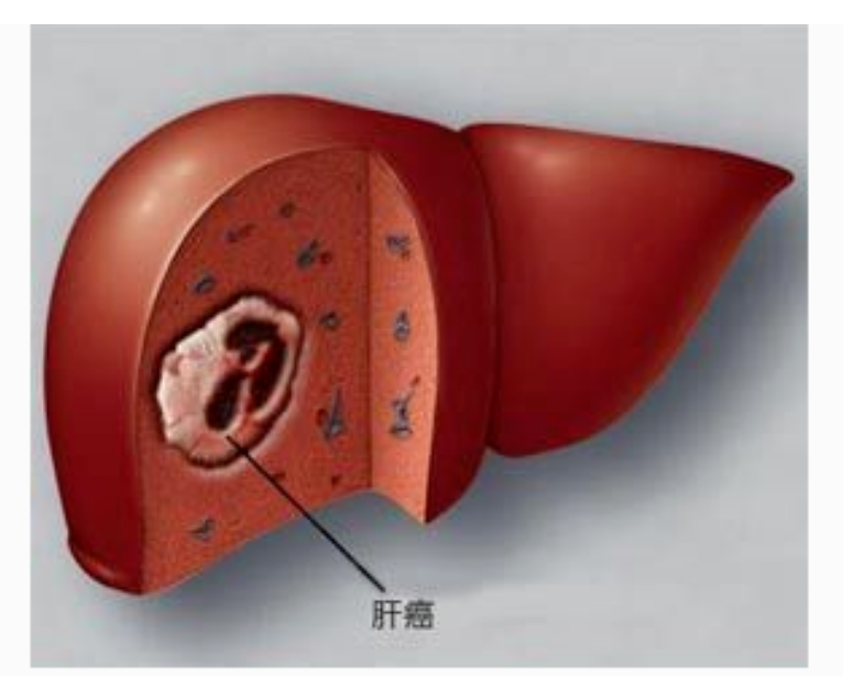 乌鲁木齐华雍堂中医馆——中医如何改善肺癌晚期、肝占位性病变、纵隔淋巴结恶性肿瘤（医案）