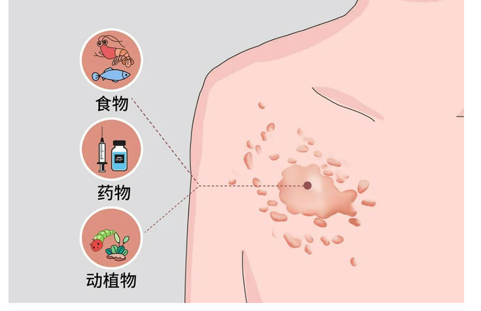 乌鲁木齐华雍堂中医馆——中医治疗过敏性皮肤病（医案）