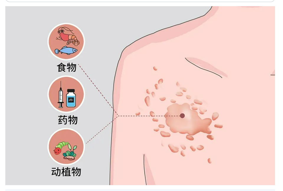 乌鲁木齐华雍堂中医馆——中医治疗过敏性皮肤病（医案）