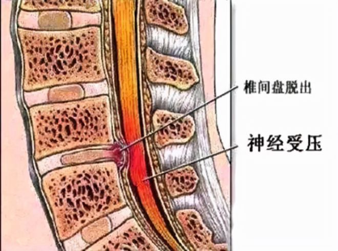 武汉诚顺和中医门诊部：柳新樵医师治疗腰椎间盘突出症