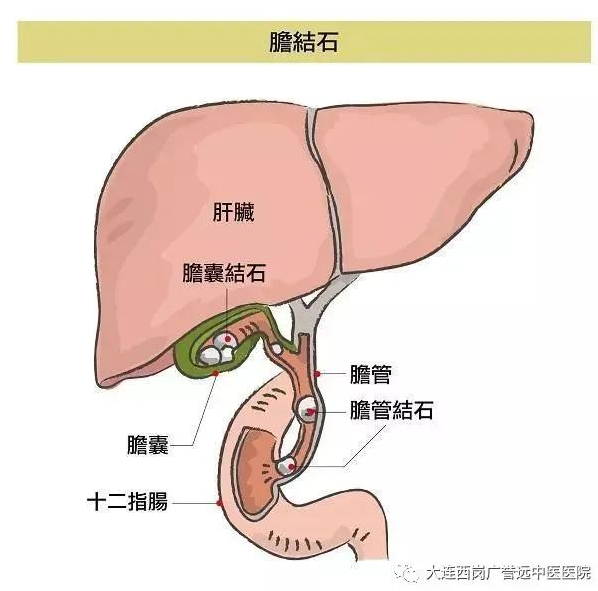 大连西岗广誉远中医医院：刘艳娥治疗胆结石