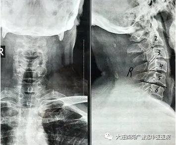 大连西岗广誉远中医医院：刺络拔罐+针灸治疗上肢酸麻肿痛