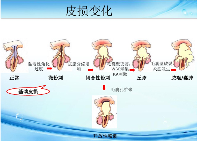 太原广誉远中医门诊部：贾颖治疗面部痤疮