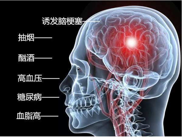 西安真爱广誉远国医馆：何玲教授用针灸治疗脑梗