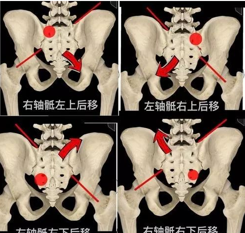 骨盆前倾图片解剖图图片