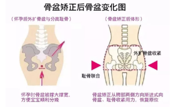 深圳康和堂中医诊：蔡达霖复位手法加针灸调理骨盆错位