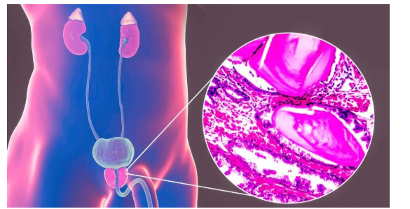 深圳积善堂中医诊所：怎么判断自己是否得了前列腺炎？