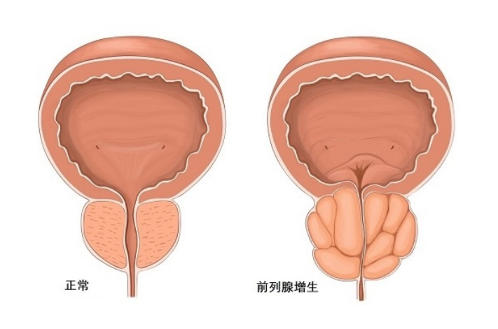 邢台康男中医院：前列腺增生的临床表现