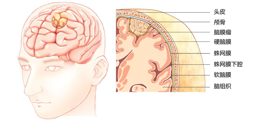郑州惠仁中医肿瘤医院：脑膜瘤术后饮食要注意事项