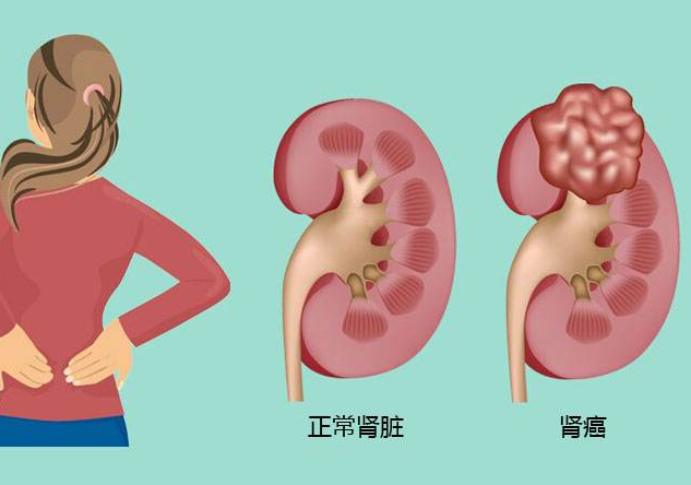 郑州惠仁中医肿瘤医院：肾癌转移后的治疗方式