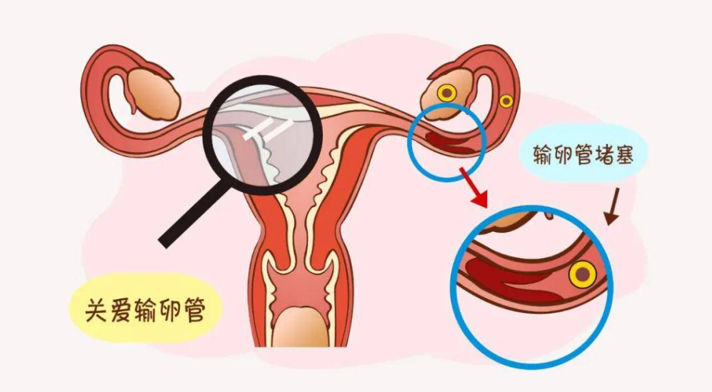 郑州美信中医院：多少女性心存侥幸，以为一侧输卵管通畅就有50%怀孕几率？