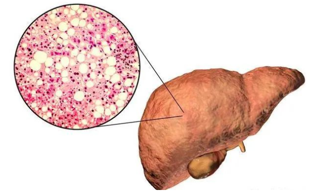 深圳展医堂紫薇中医诊所：体检报告里的脂肪肝“小心机”！