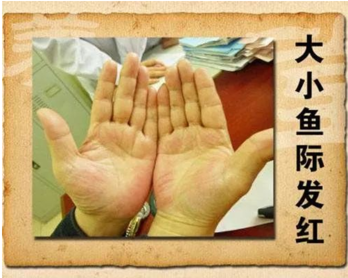 深圳展医堂紫薇中医诊所：体检报告里的脂肪肝“小心机”！