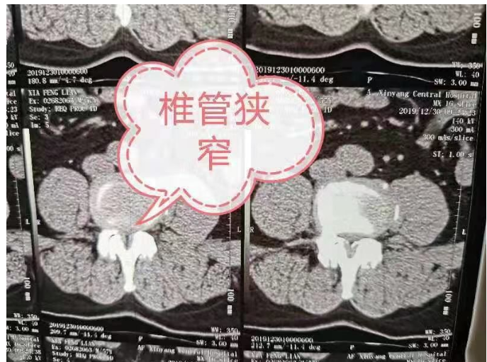 郑州德馨中医院：正骨、筋骨针治疗腰椎间盘突出并椎管狭窄症