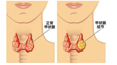 武汉江岸康宁中医门诊部：预防结节，要从情绪开始呦