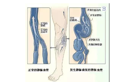 郑州福德堂中医院：石应轩调理静脉曲张